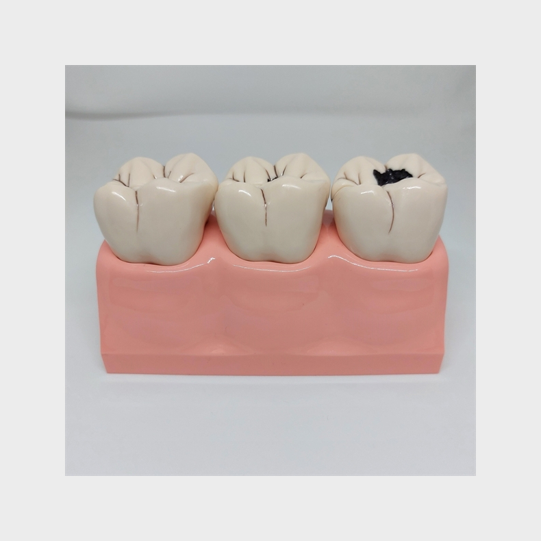 Stor Caries Studiemodel 